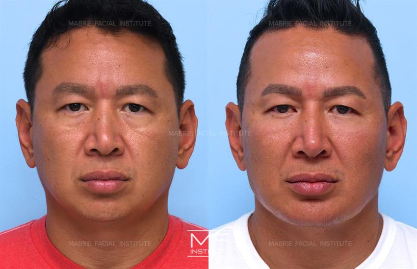 Before & After contouring for Squarer Chin face shape