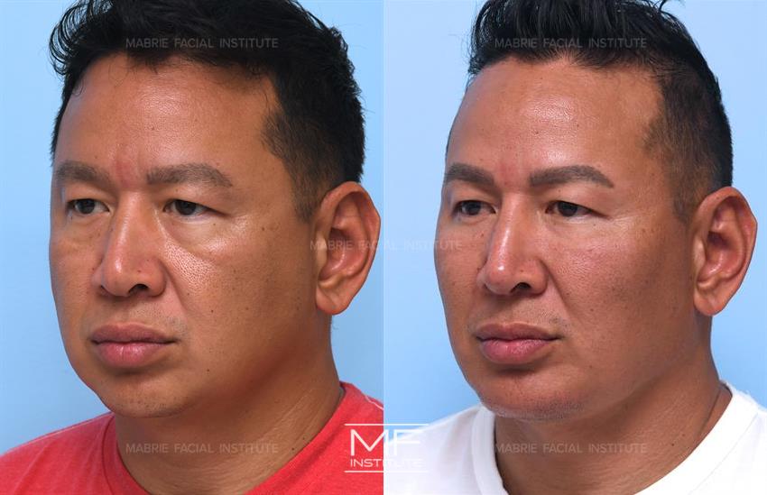 Before & After contouring for example face shape